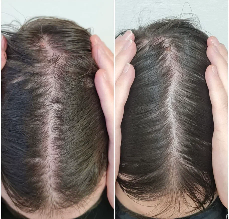 домашняя мезотерапия для волос | Дзен