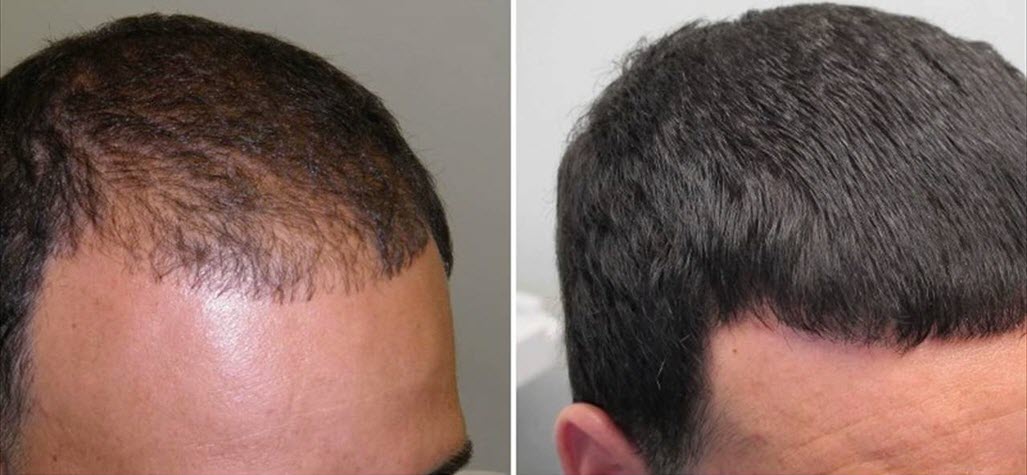 Противопоказания к лечению выпадению волос у мужчин